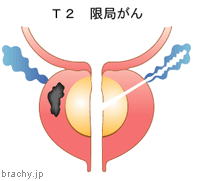 前立腺がんの進行度T2：前立腺に限局
