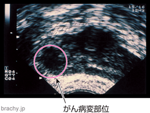 前立腺がん検査｜経直腸的超音波断層法
