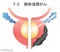 前立腺がんの進行度T3：前立腺被膜をこえて進展