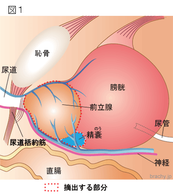 前立腺がんで摘出する部分を示したイラスト